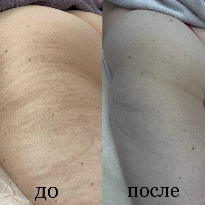 Эндосфера терапия фото